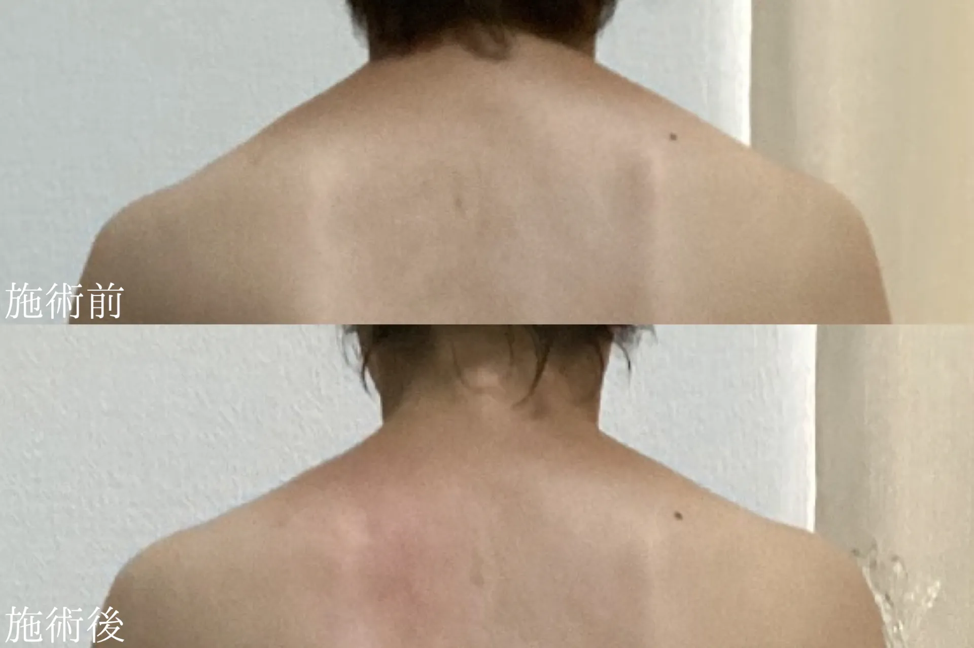 長年悩んでいた肩こり改善