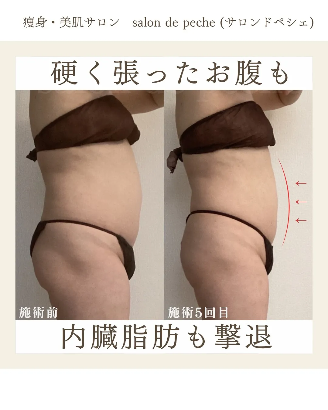 硬く張ったお腹も、内臓脂肪も撃退!【安佐南区/中筋/痩身】