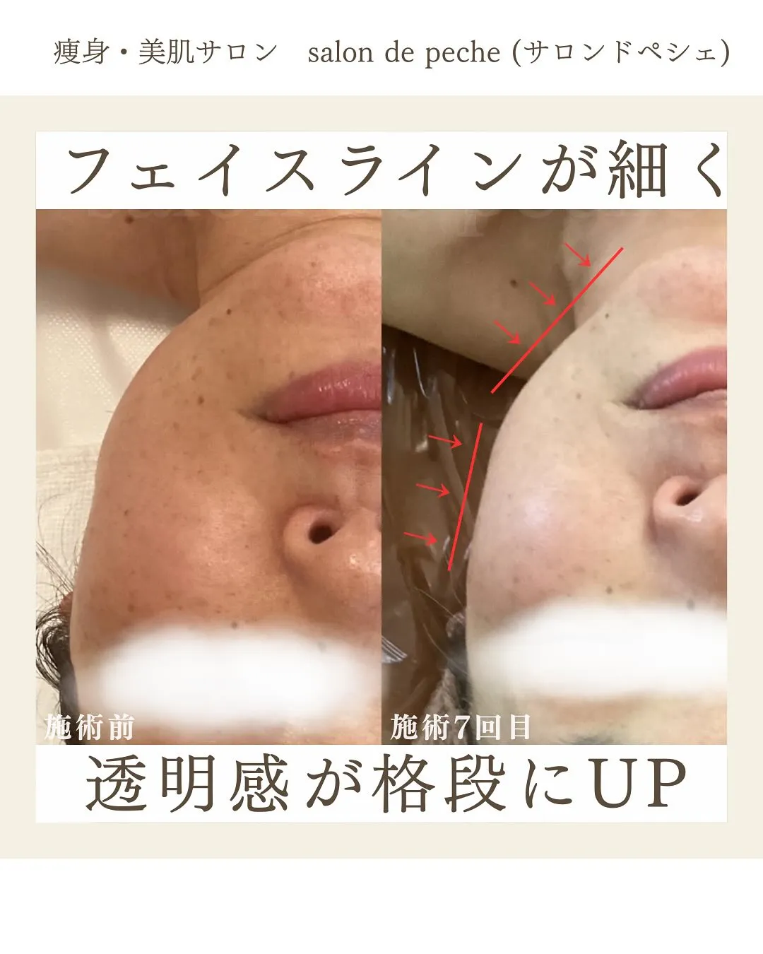 50代女性＊小顔コース7回目の変化【安佐南区/小顔/シミシワ...