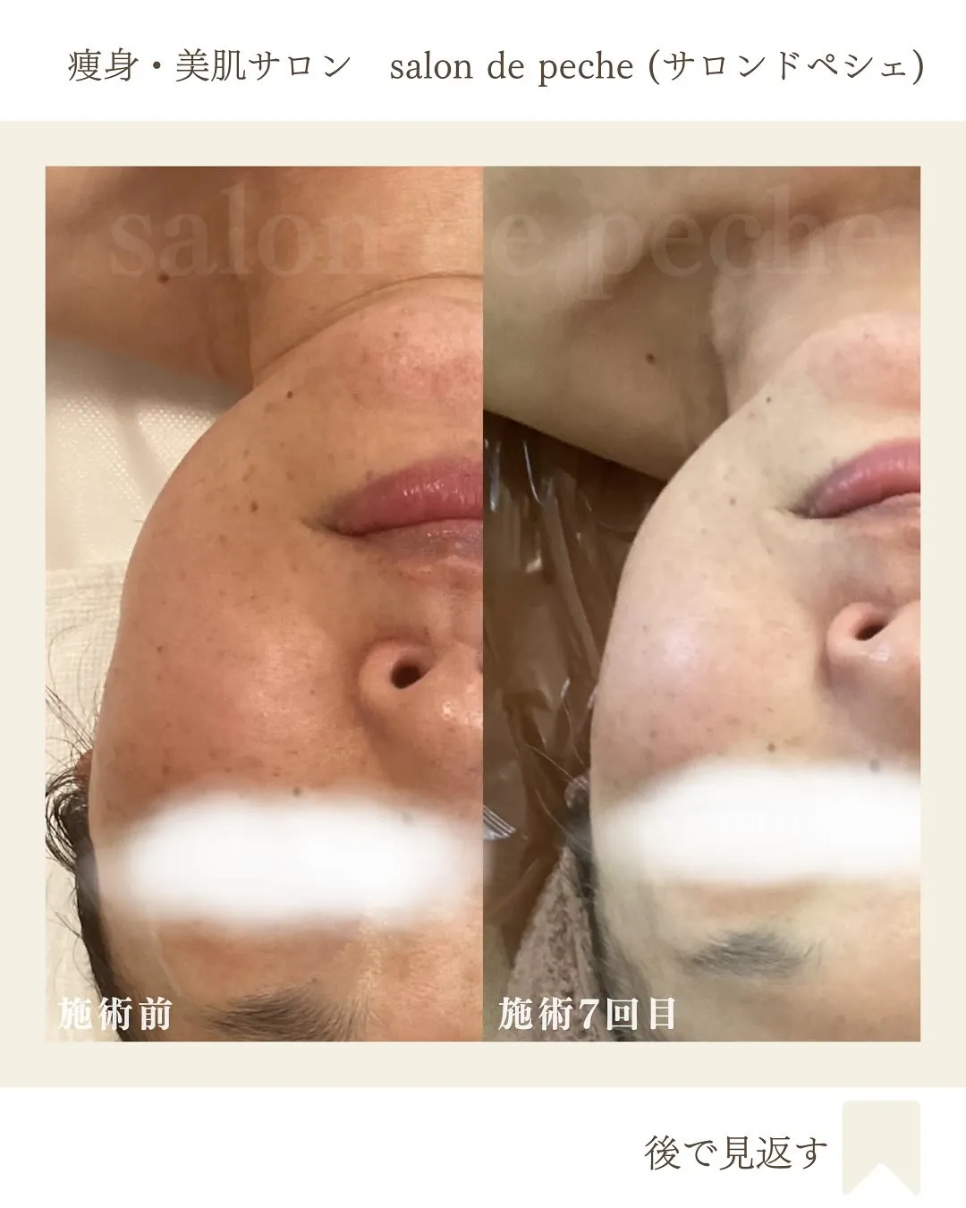 50代女性＊小顔コース7回目の変化【安佐南区/小顔/シミシワ...