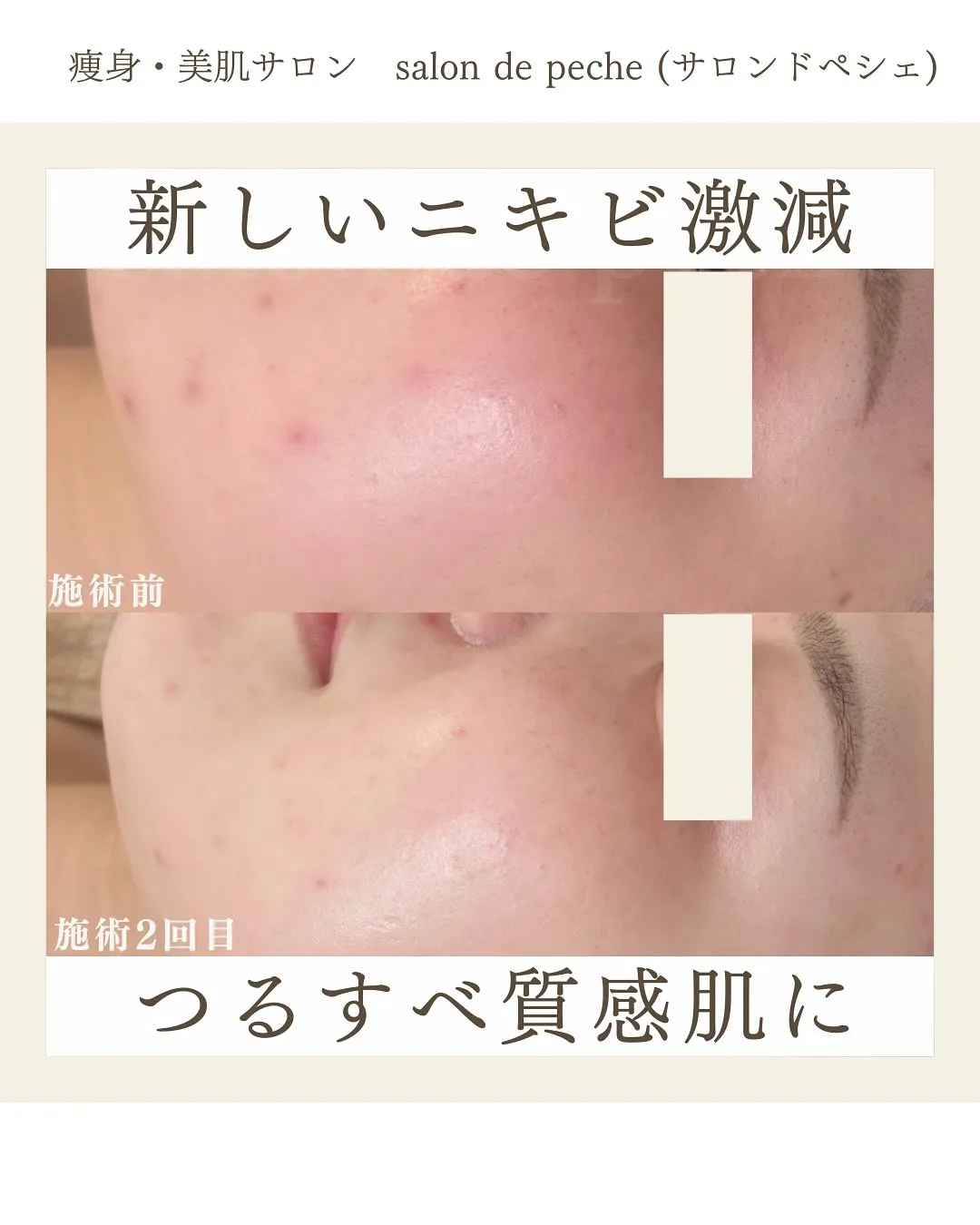 ハーブピーリング2回での変化【安佐南区/エステ/ハーブピーリ...