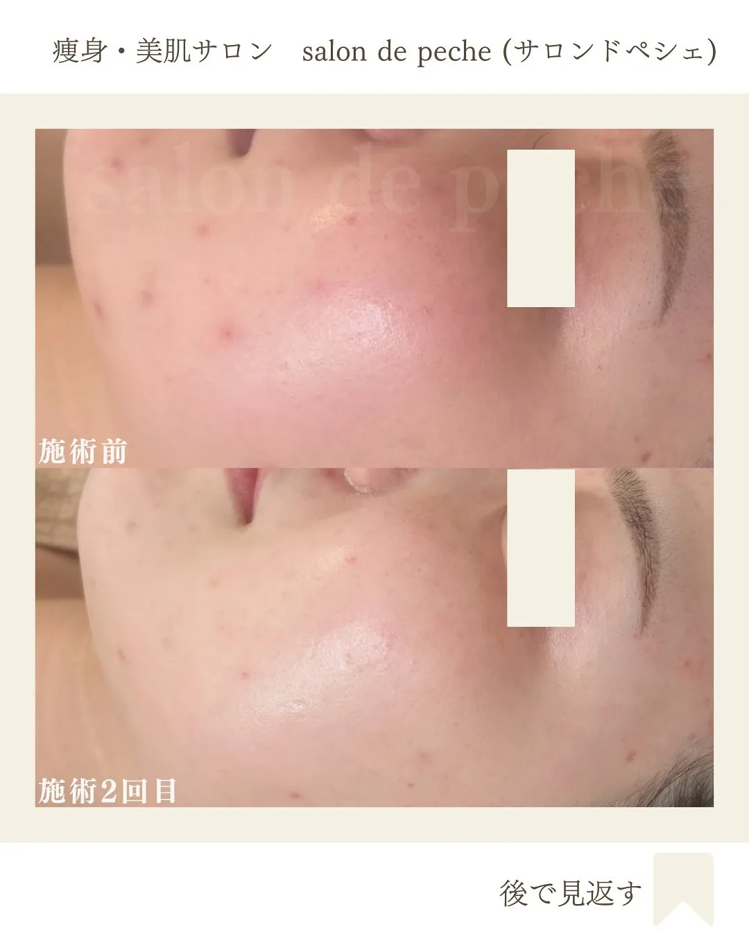 ハーブピーリング2回での変化【安佐南区/エステ/ハーブピーリ...