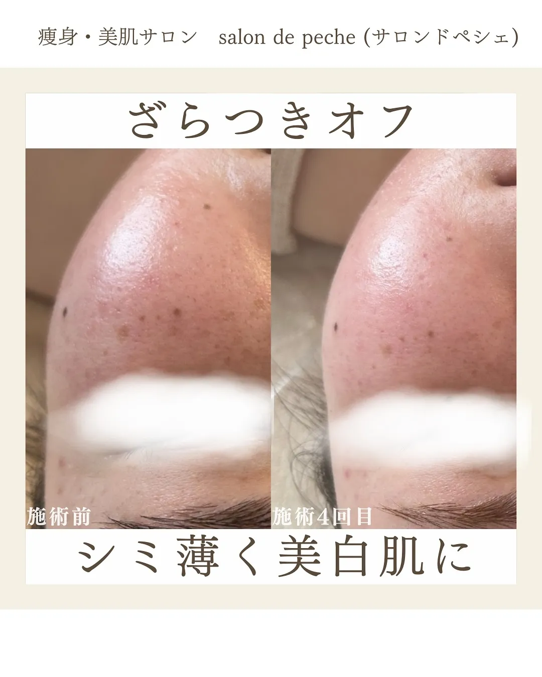 ハーブピーリング4回の変化【安佐南区/ハーブピーリング/美白...
