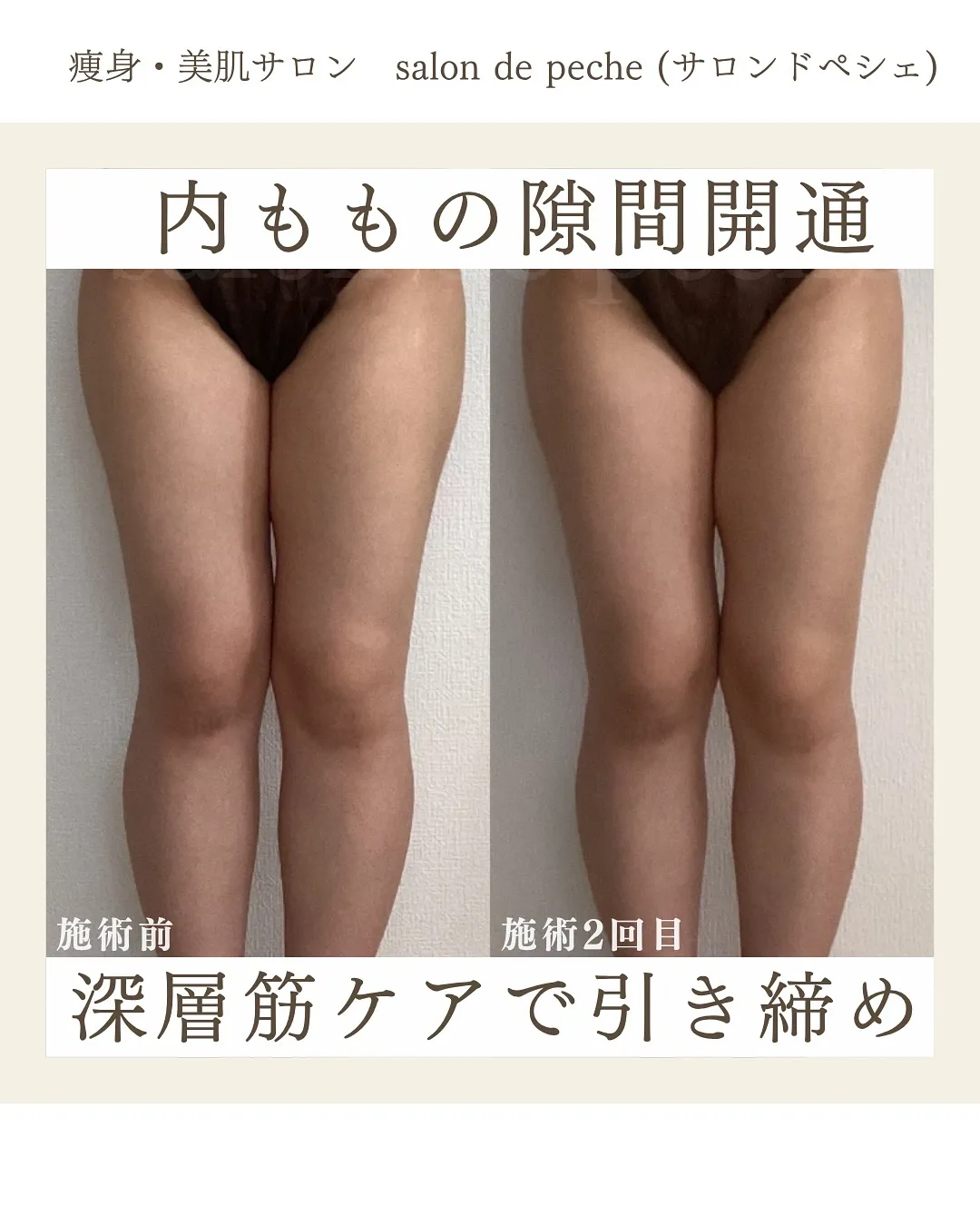 内ももの隙間痩せ【安佐南区/足痩せ/内もも痩せ】