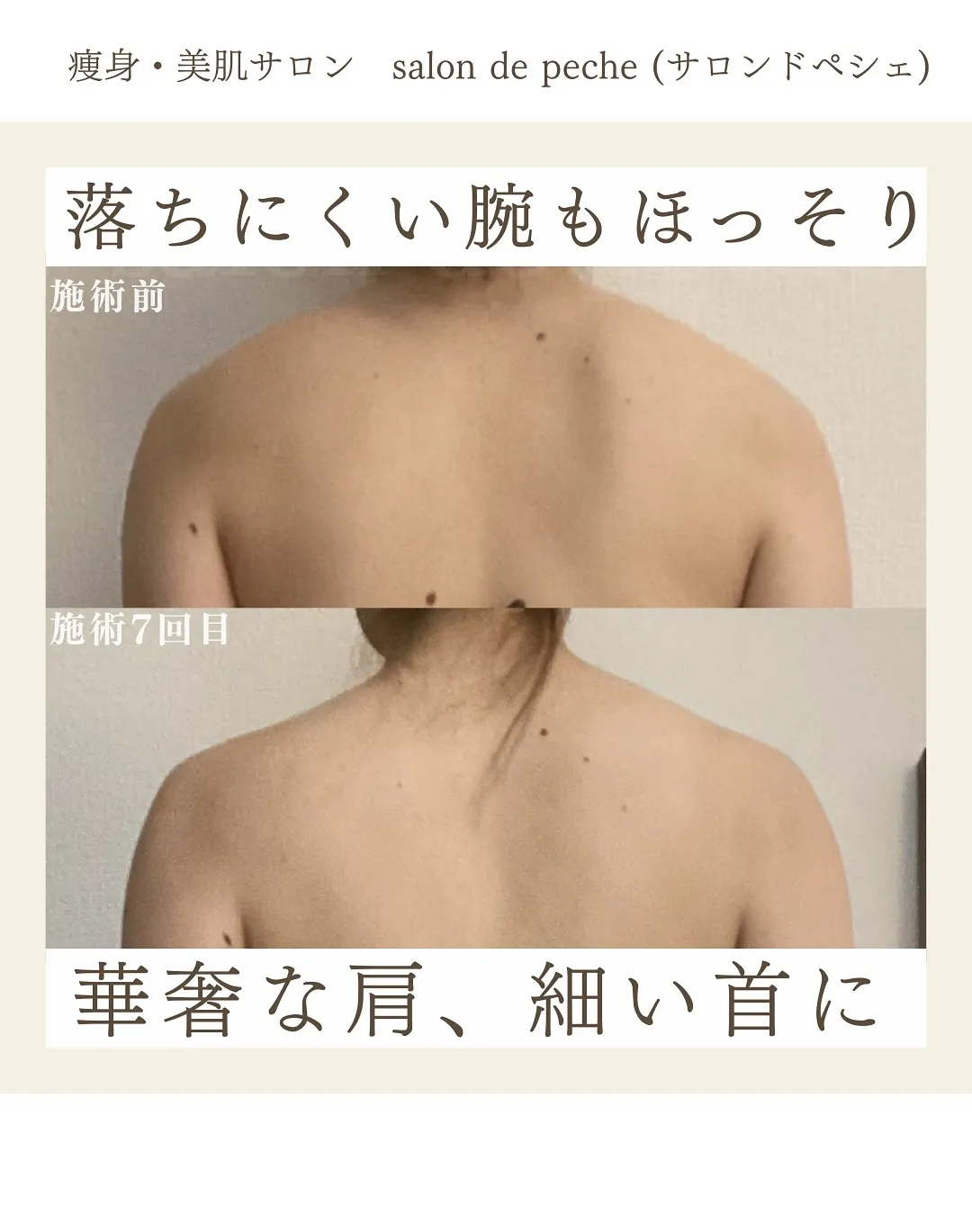 20代＊痩身コース7回の変化【広島市/ダイエット/腕痩せ/肩...