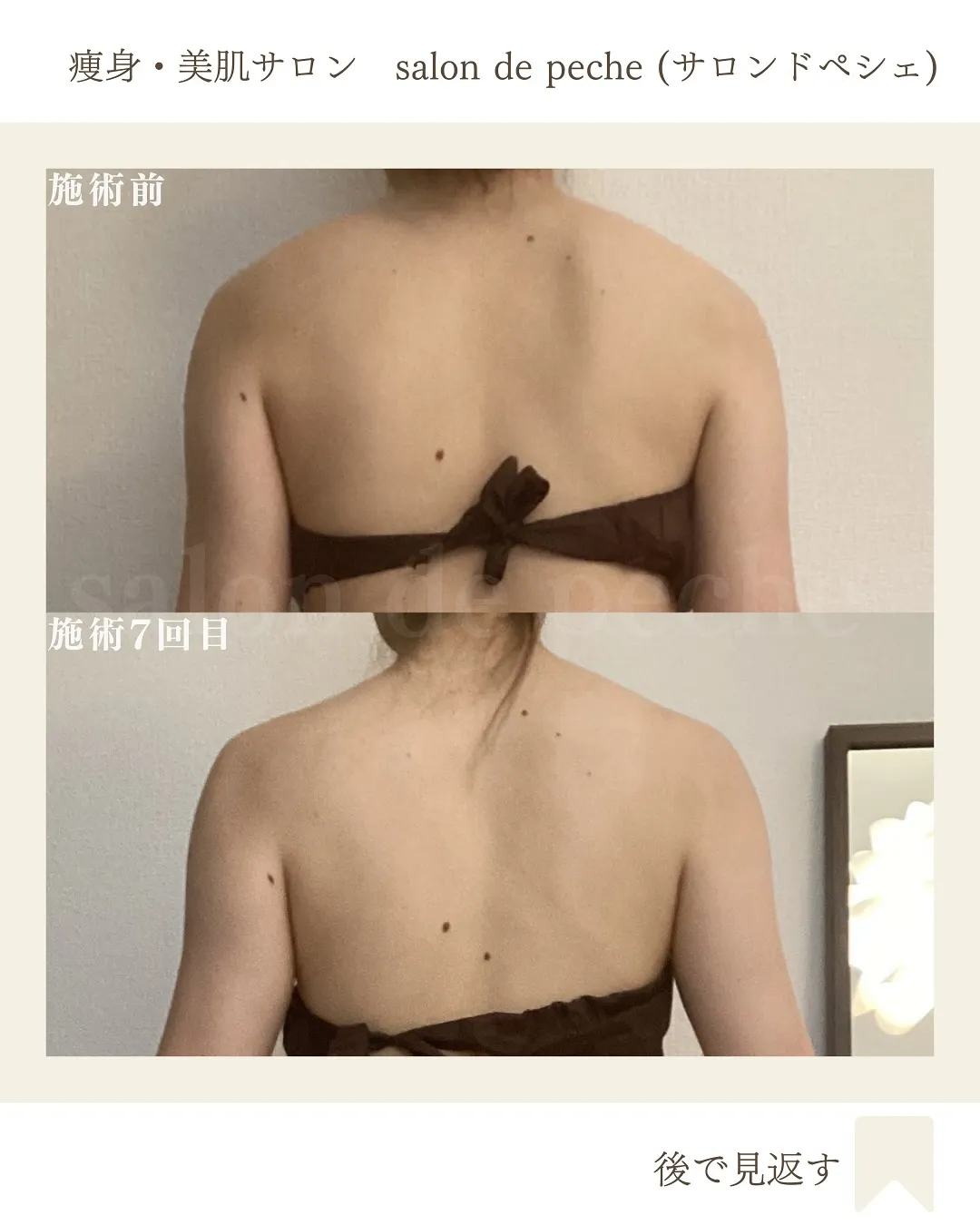 20代＊痩身コース7回の変化【広島市/ダイエット/腕痩せ/肩...