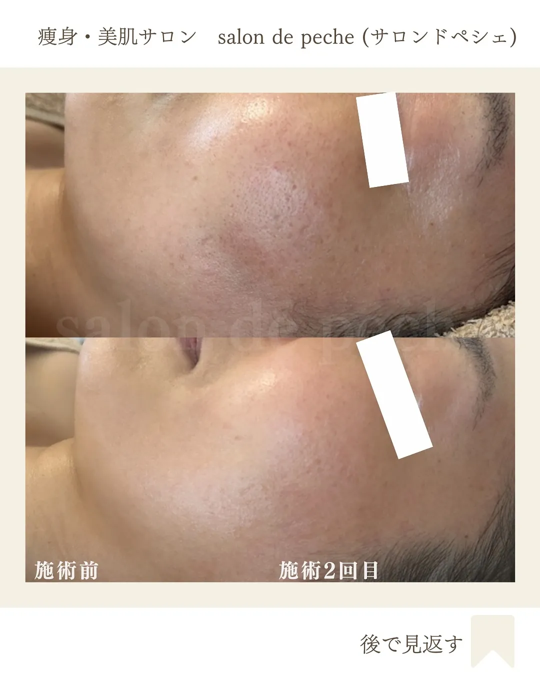 ハーブピーリングで毛穴が小さく、トーンUP【広島市/エステ】