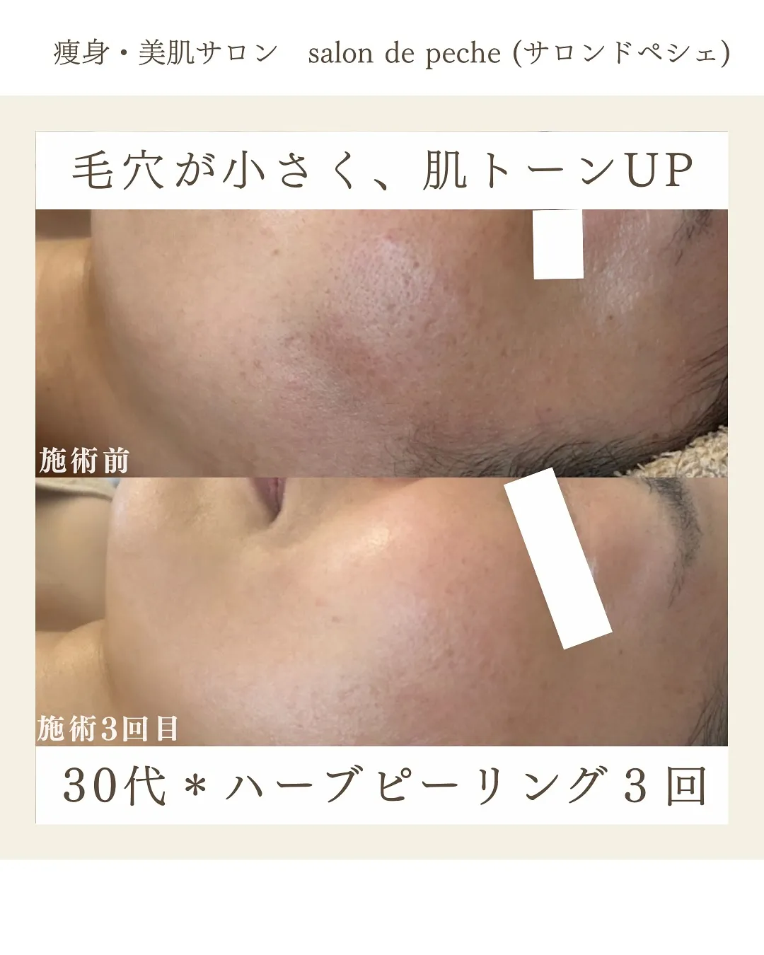 ハーブピーリングで毛穴が小さく、トーンUP【広島市/エステ】