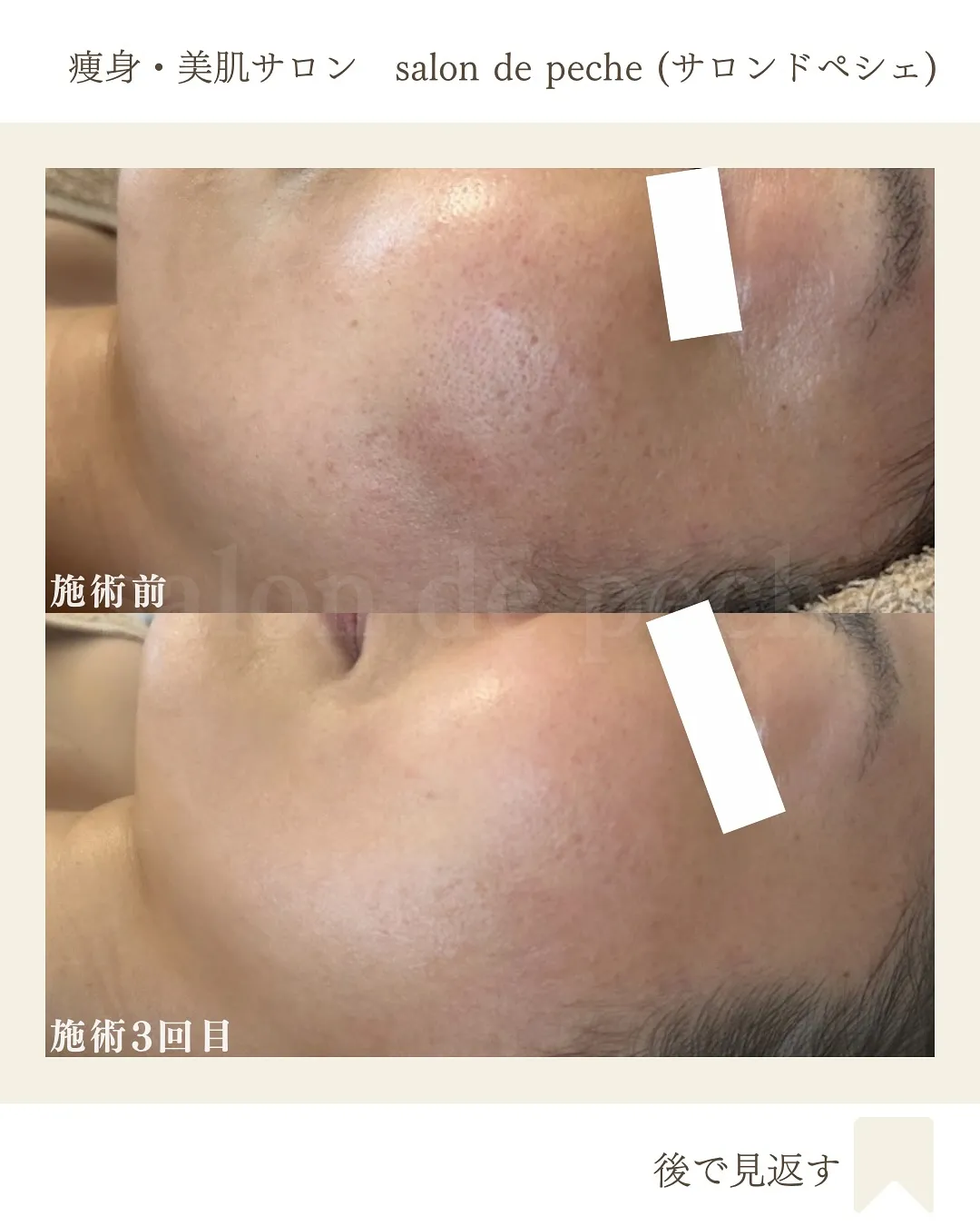 ハーブピーリングで毛穴が小さく、トーンUP【広島市/エステ】