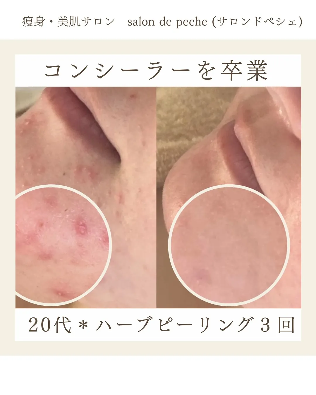 20代✴︎コンシーラーを卒業できる素肌へ【広島市/エステ/美...