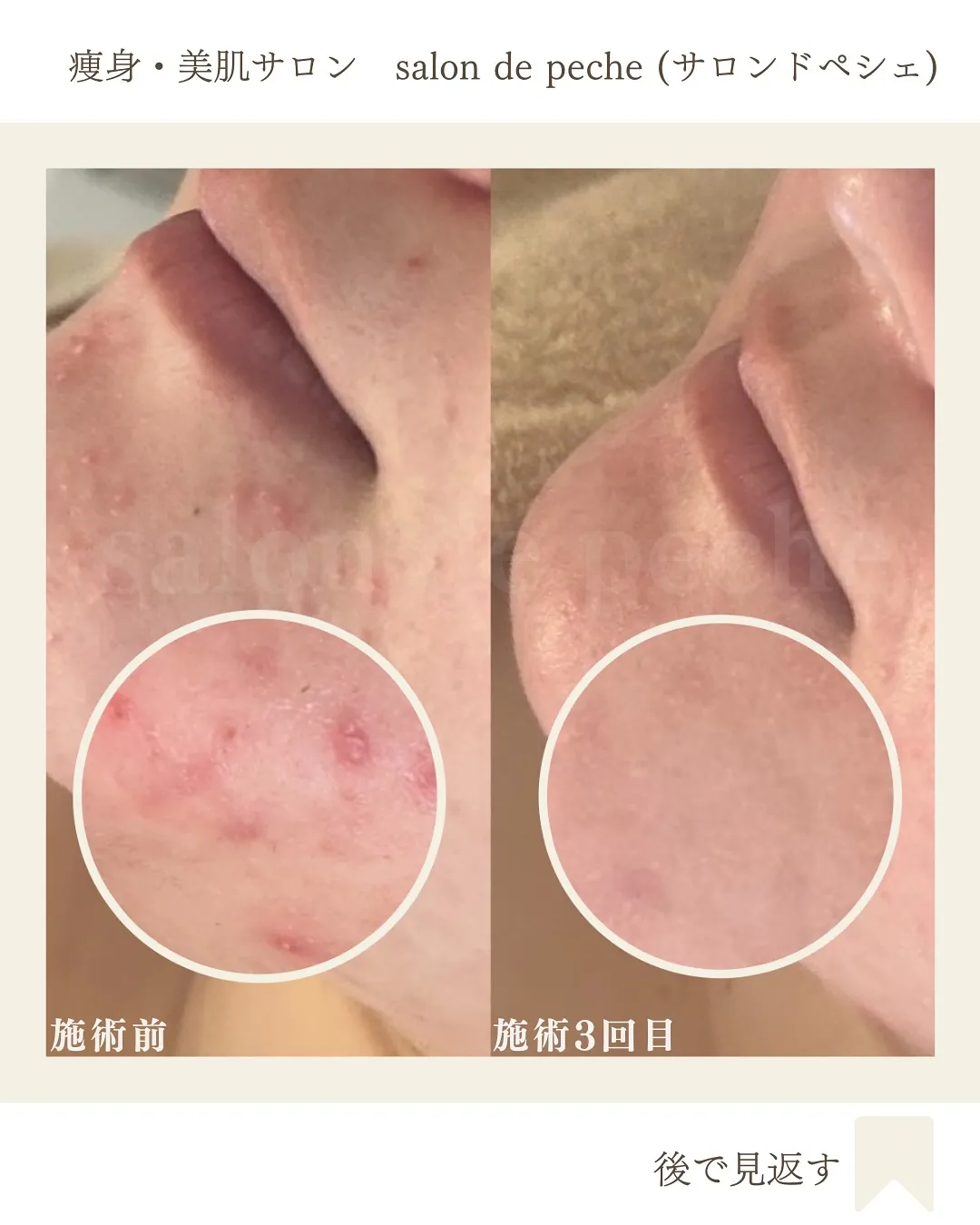 20代✴︎コンシーラーを卒業できる素肌へ【広島市/エステ/美...