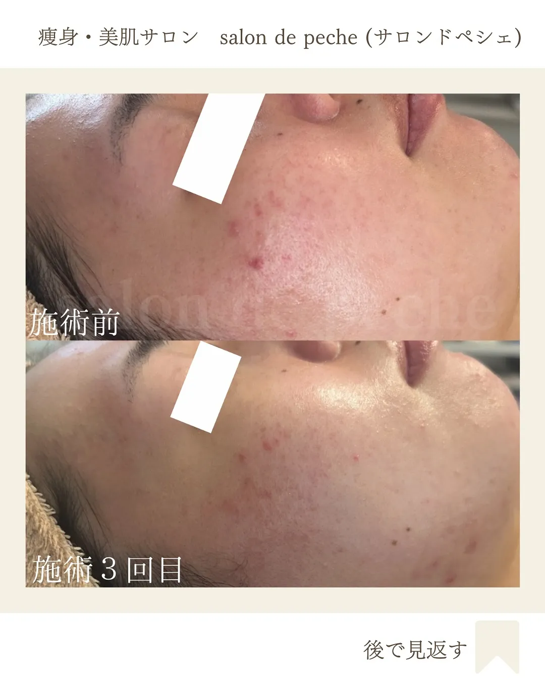 【20代＊ハーブピーリング3回】広島市/毛穴/小顔