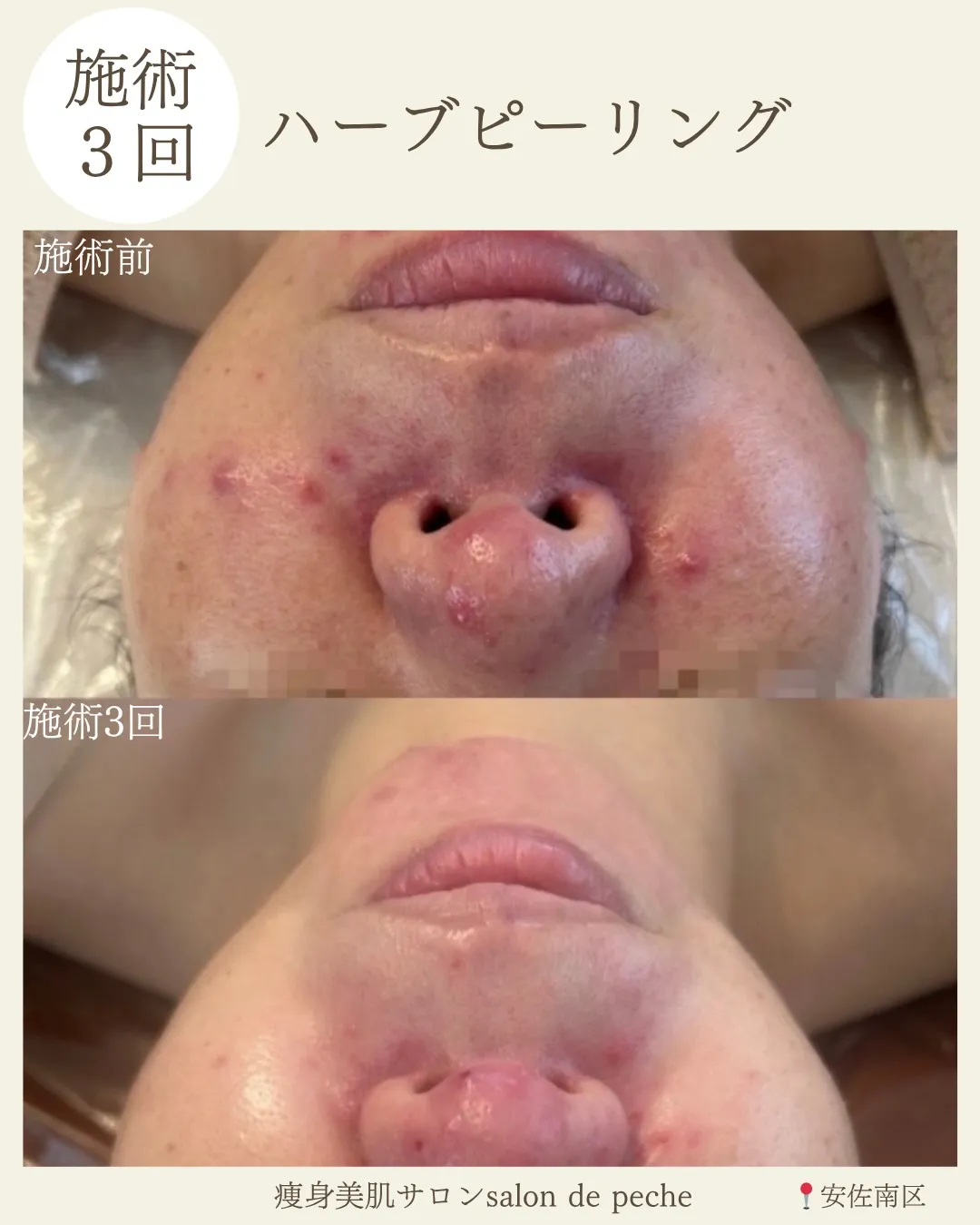 ハーブピーリング3回の変化【安佐南区/安佐北区/ニキビケア】