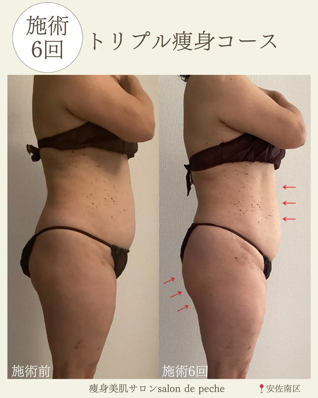 トリプル痩身コース60分・6回の変化【広島市/オイルマッサー...