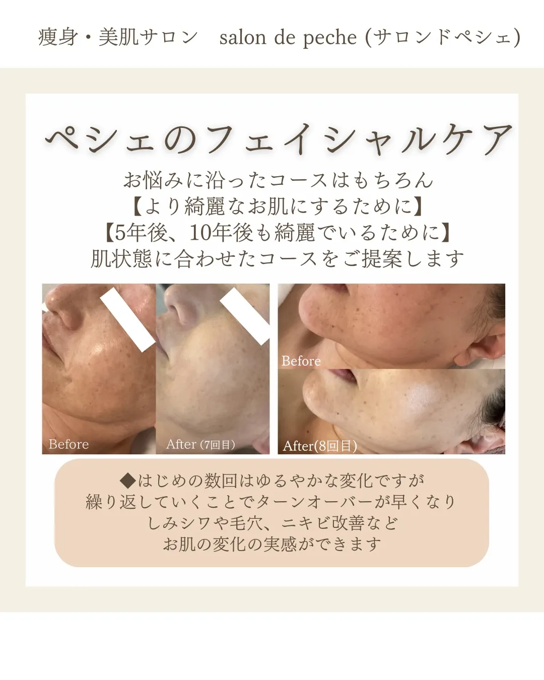 美白乳酸ピーリング3回の変化【安佐南区/エステ/シミ/ニキビ...