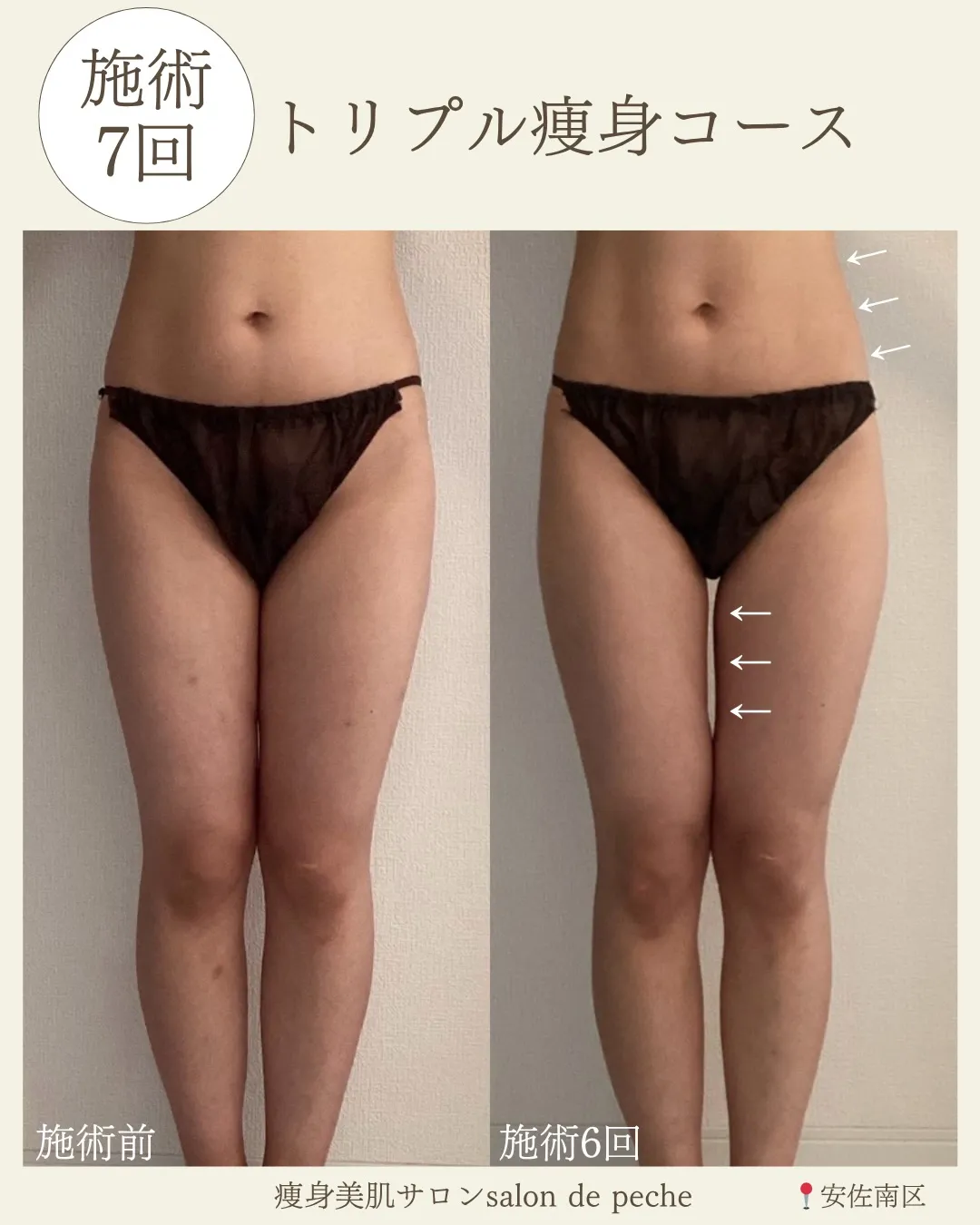 30代からでも脚のすき間スッキリ⭐️【安佐南区/痩身/足痩せ...