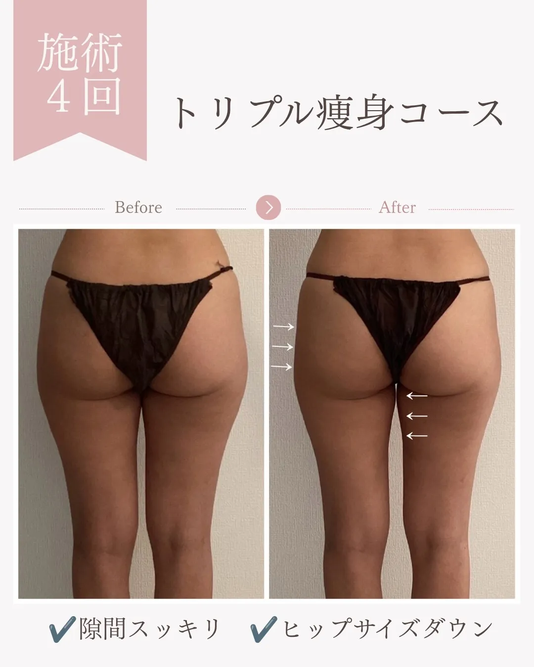 トリプル痩身コース4回の変化【安佐南区/エステ/ダイエット】