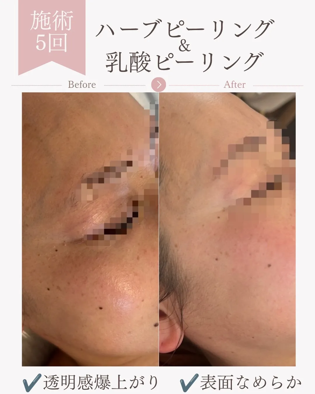 ハーブピーリング&乳酸ピーリング5回の変化【安佐南区エステ/...