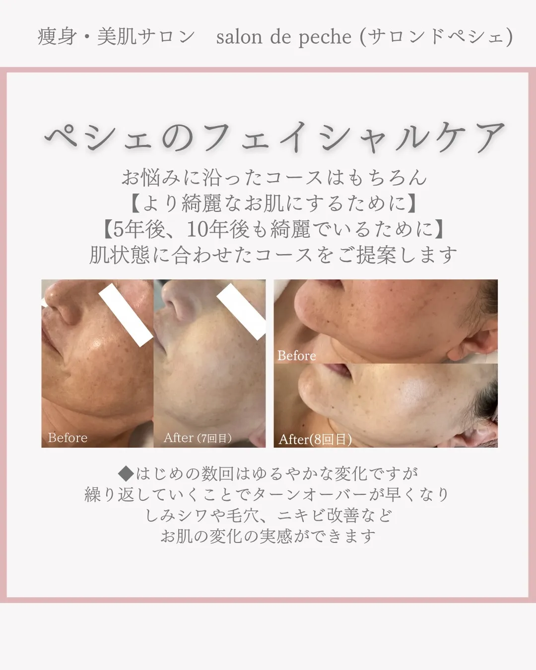 ハーブピーリング&乳酸ピーリング5回の変化【安佐南区エステ/...