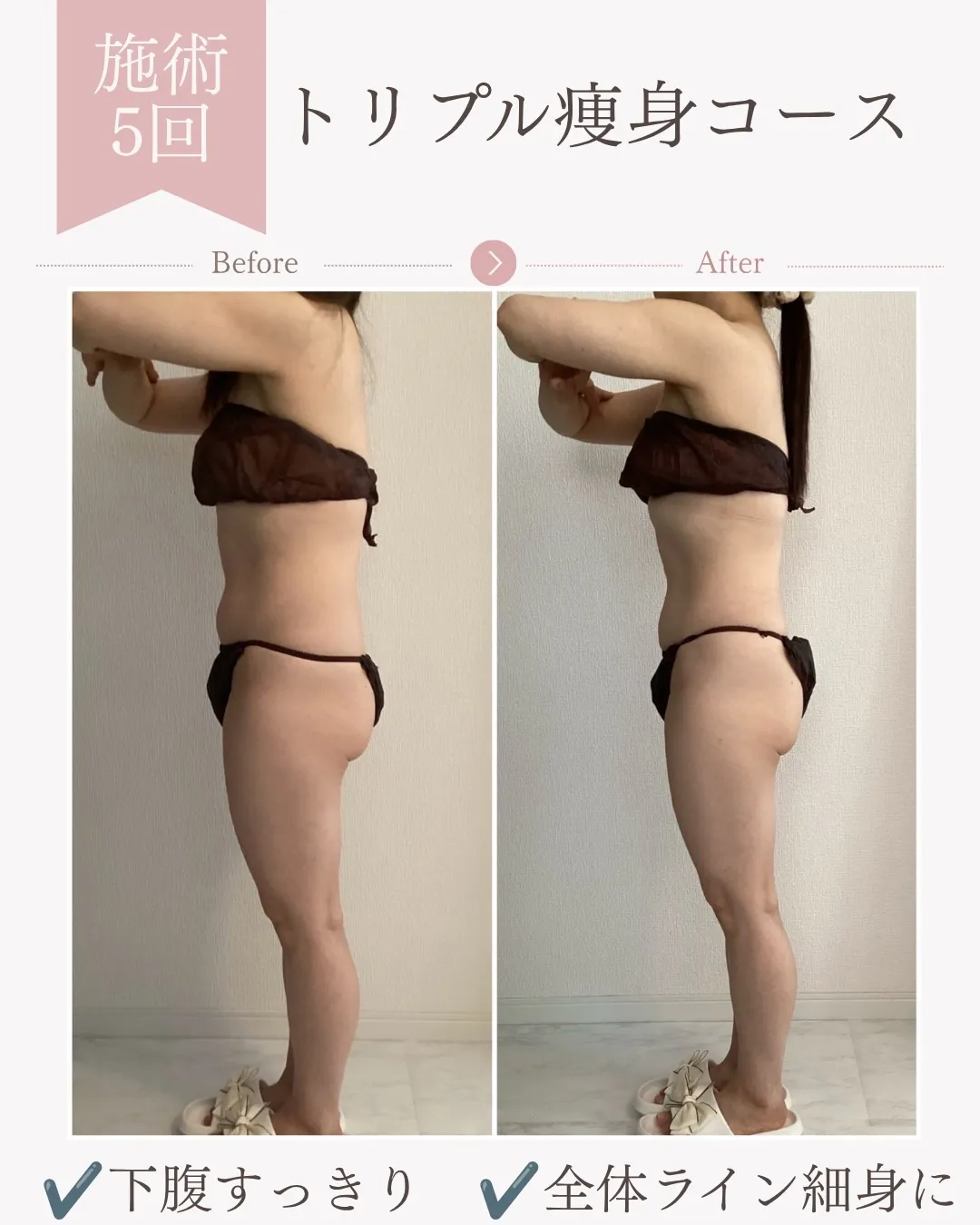 トリプル痩身コース5回の変化【安佐南区エステ/足痩せ/お腹痩...