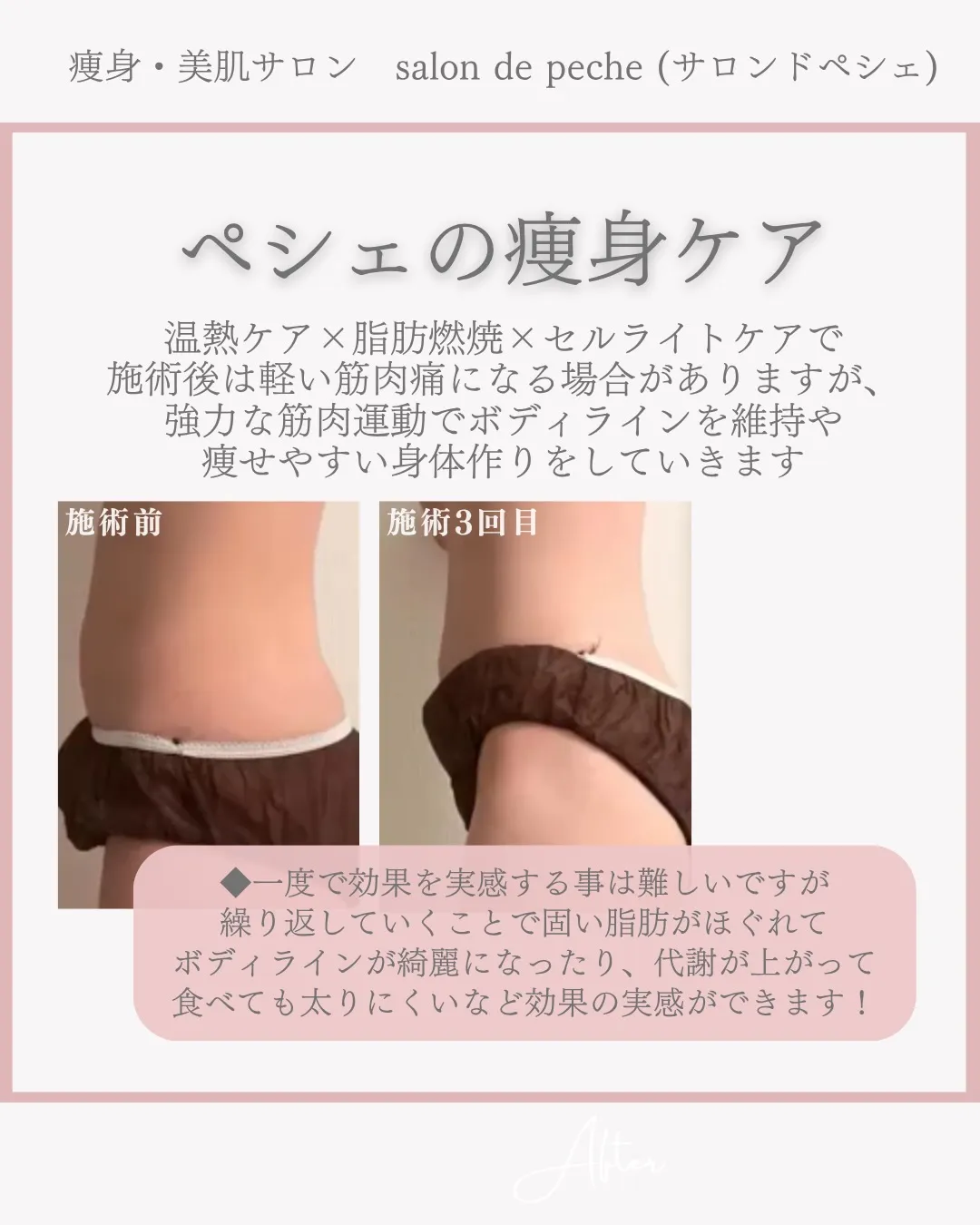 トリプル痩身コース5回の変化【安佐南区エステ/足痩せ/お腹痩...