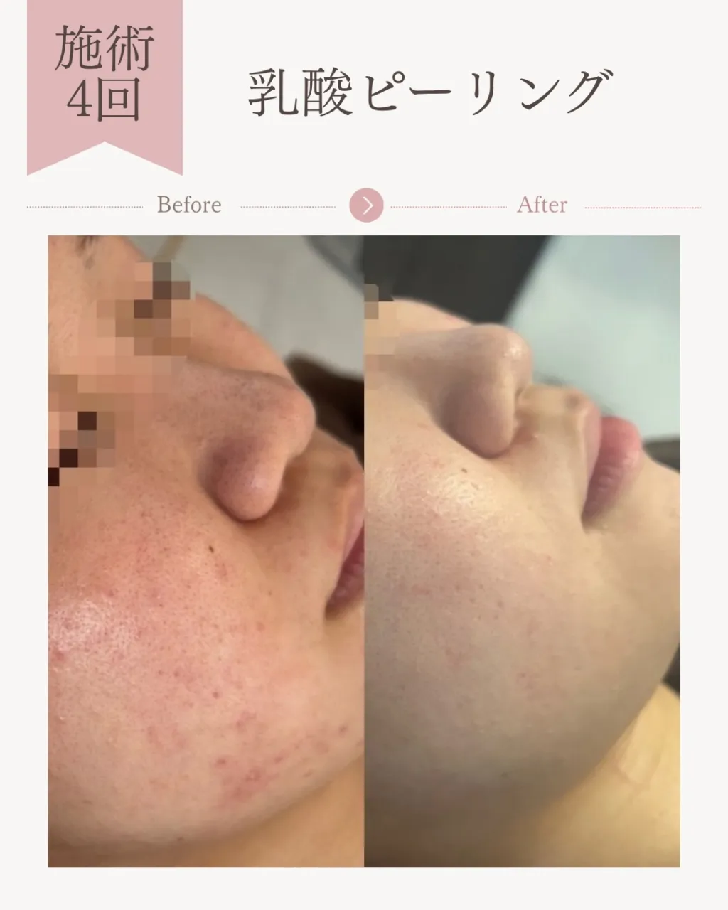 乳酸ピーリング4回の変化✨【広島市エステ/ニキビ/毛穴/美白...