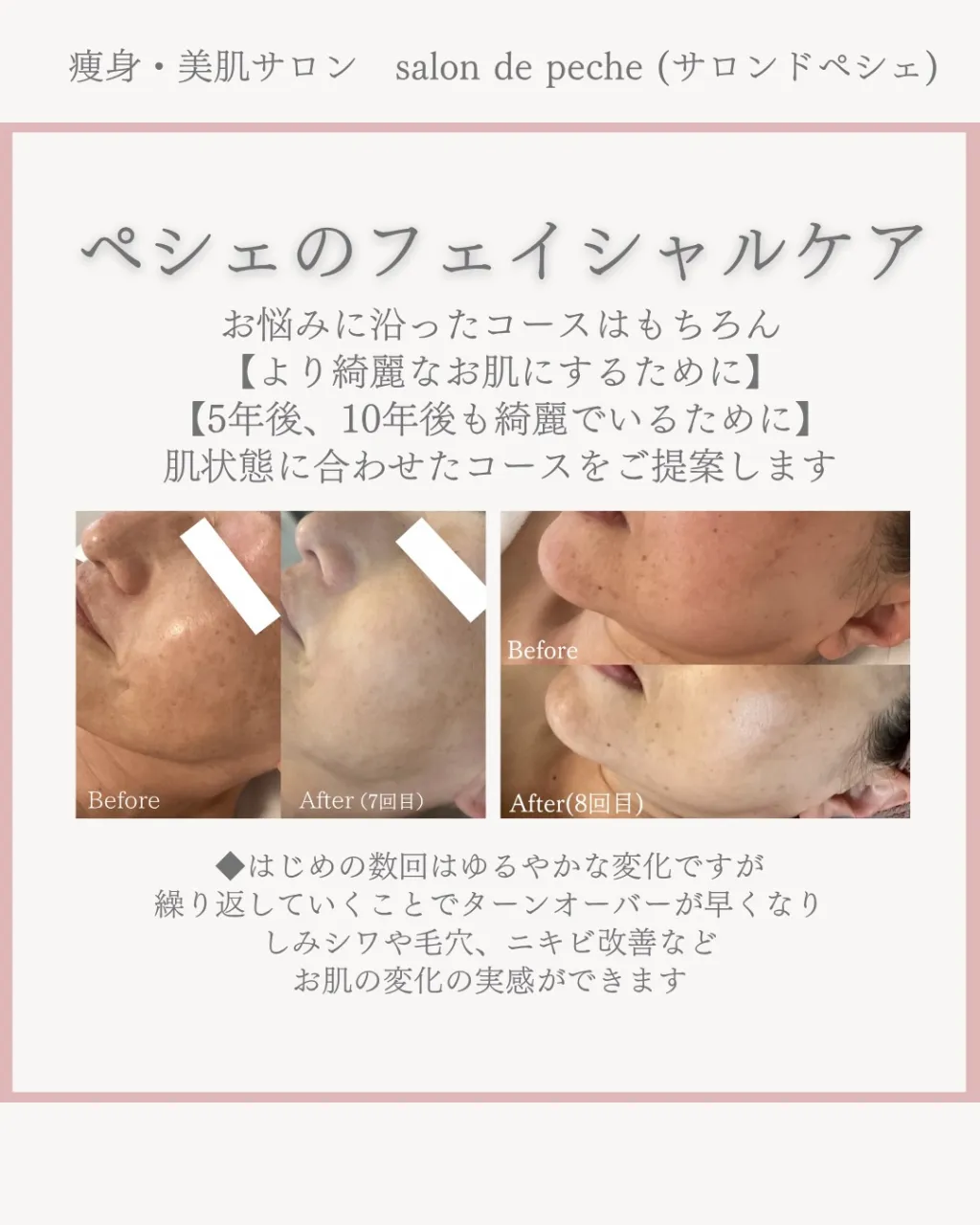 乳酸ピーリング4回の変化✨【広島市エステ/ニキビ/毛穴/美白...