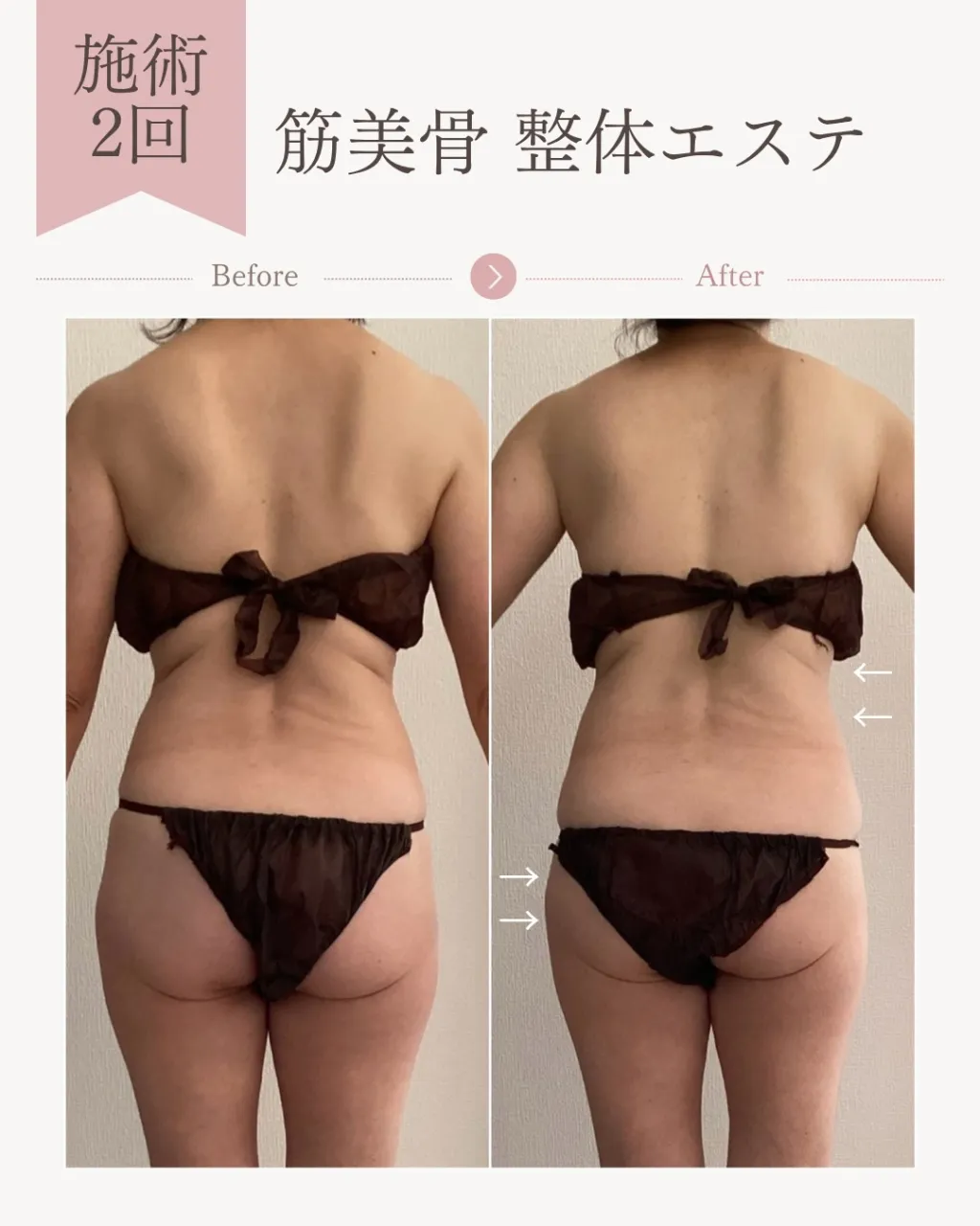 筋美骨整体エステ2回の変化 【安佐南区エステ/痩身/肩こり】