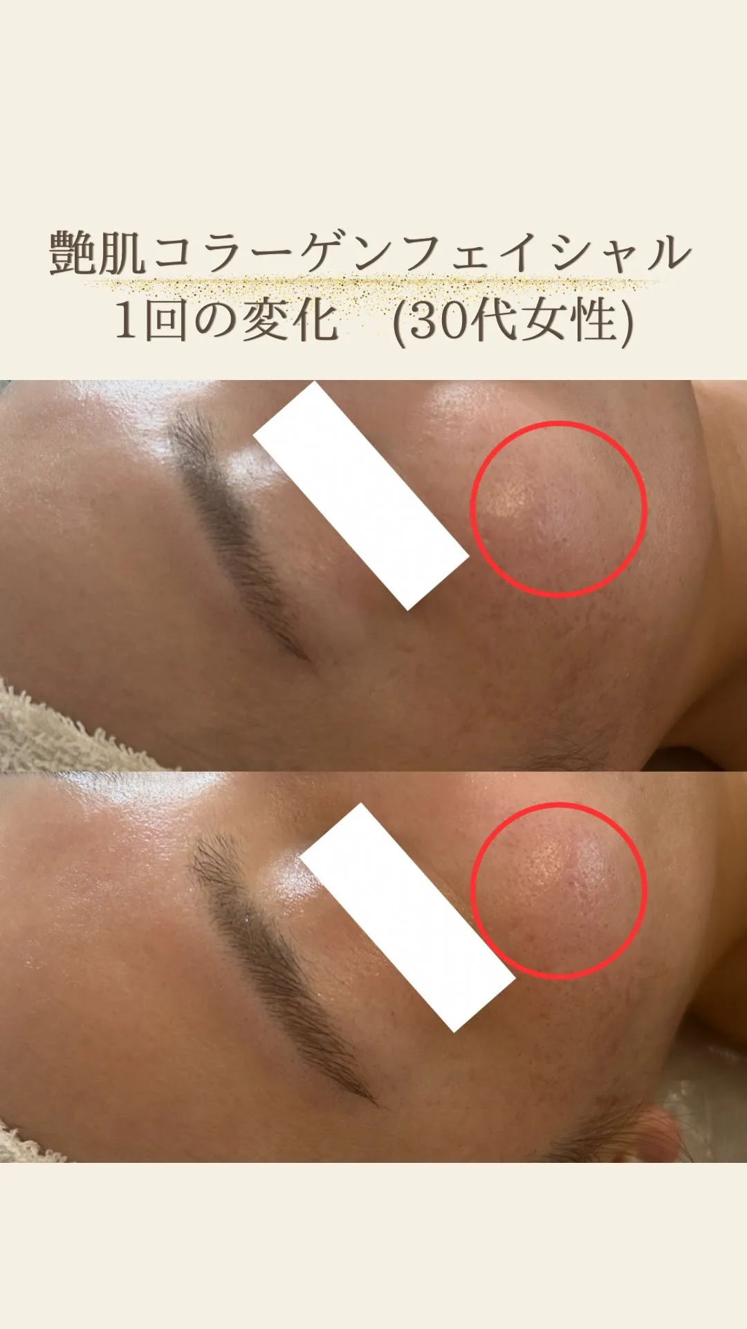 毛穴を小さく！潤いチャージ♪艶肌コラーゲンフェイシャル