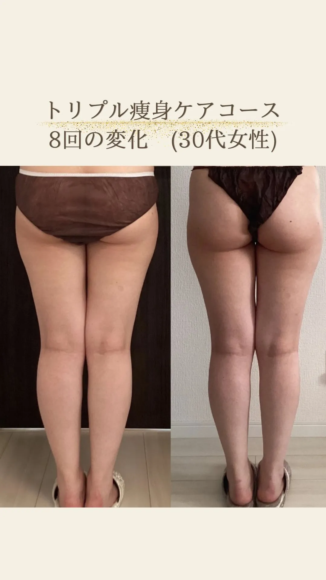 トリプル痩身ケアコース8回での変化♪すっきり美脚に！