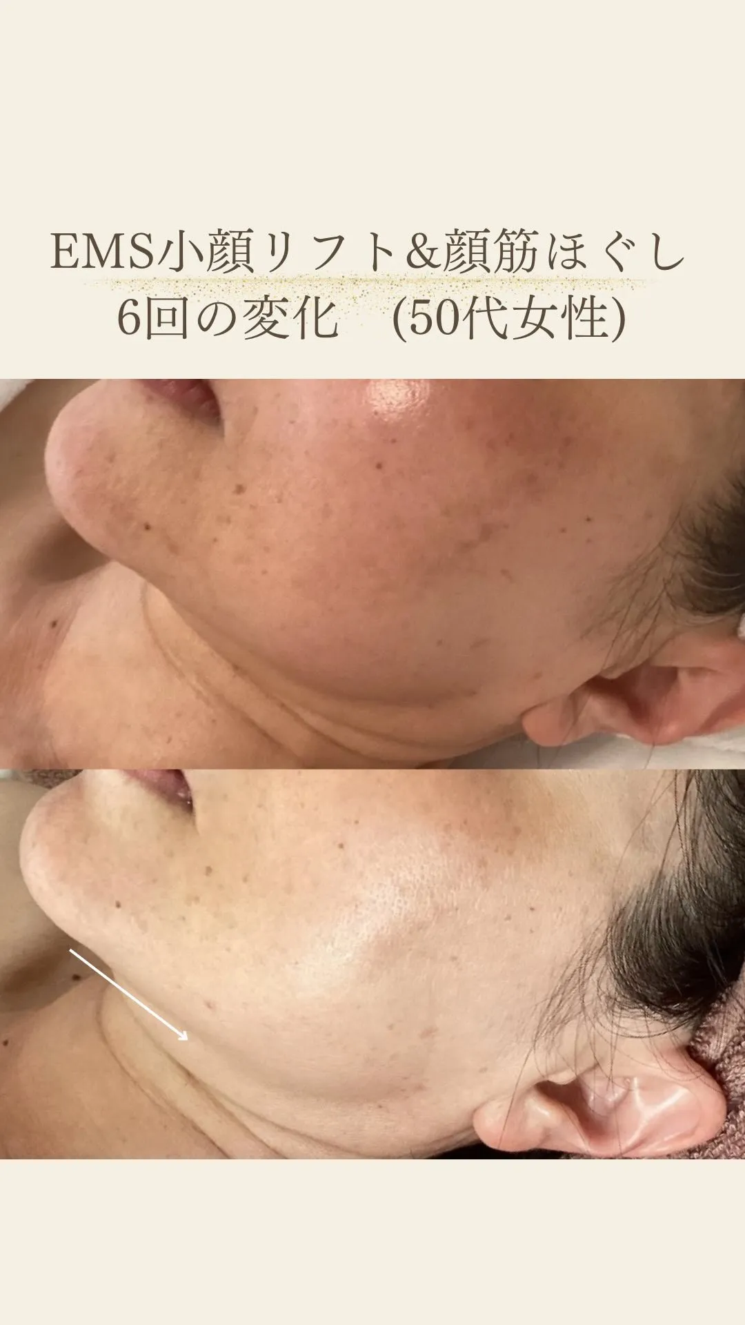 EMS小顔リフト&顔筋ほぐし6回の変化♪フェイスラインがすっ...