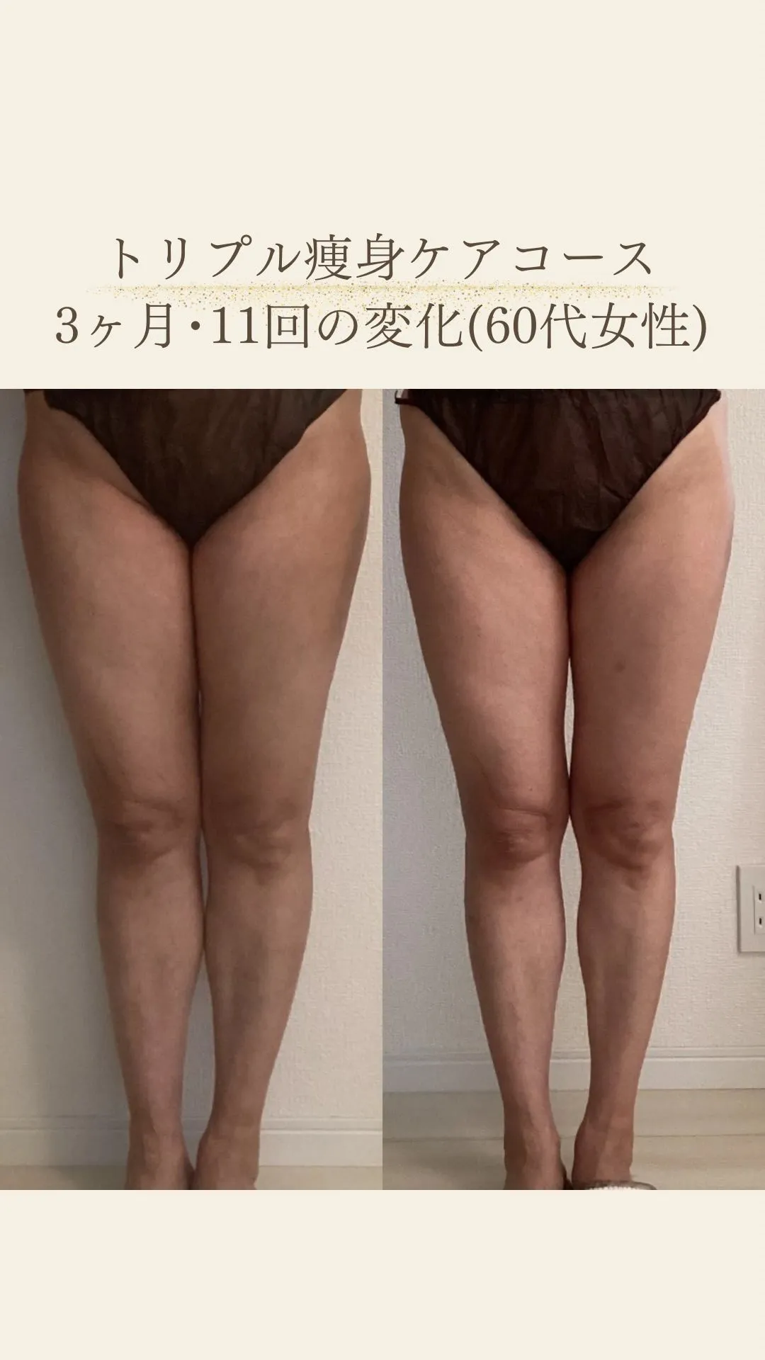 トリプル痩身ケアコース3ヶ月・11回の変化★内ももすっきり！