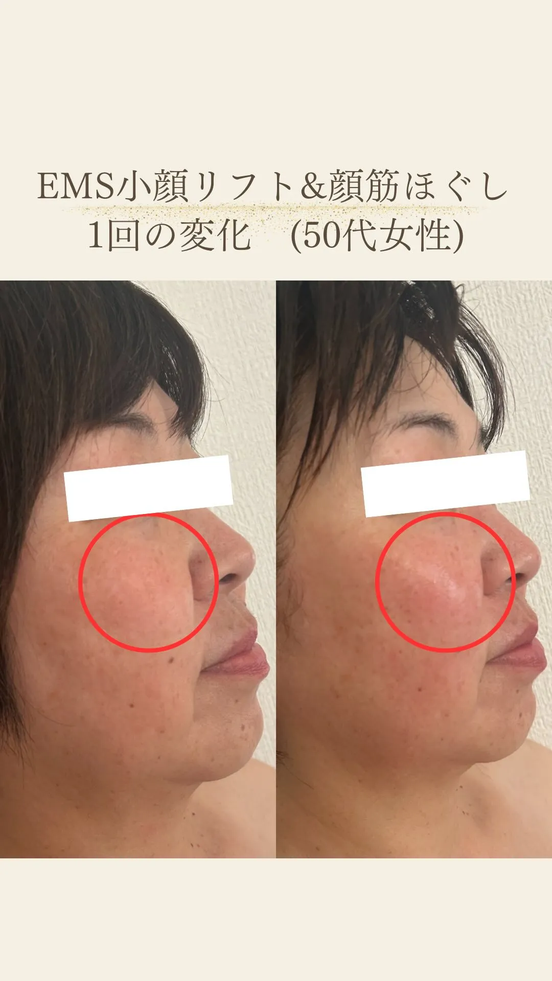 EMS小顔リフト&顔筋ほぐしフェイシャル/1回での変化