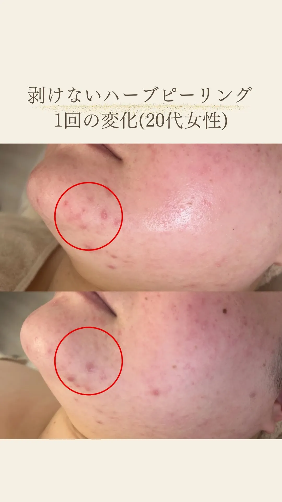20代女性＊剥けないハーブピーリング1回の変化